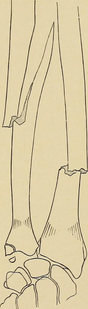 An illustration from Surgical diagnosis / by Edward Martin ... illustrated with 445 engravings and 18 plates in colors and monochrome., 1909, leaf 419
