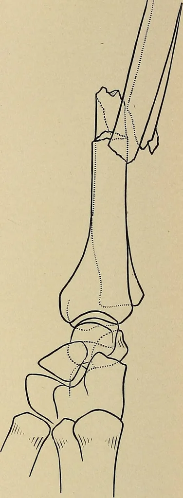 An illustration from Surgical diagnosis / by Edward Martin ... illustrated with 445 engravings and 18 plates in colors and monochrome., 1909, leaf 420