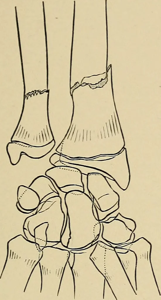 An illustration from Surgical diagnosis / by Edward Martin ... illustrated with 445 engravings and 18 plates in colors and monochrome., 1909, leaf 421