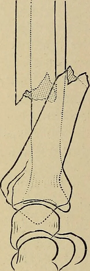 An illustration from Surgical diagnosis / by Edward Martin ... illustrated with 445 engravings and 18 plates in colors and monochrome., 1909, leaf 426