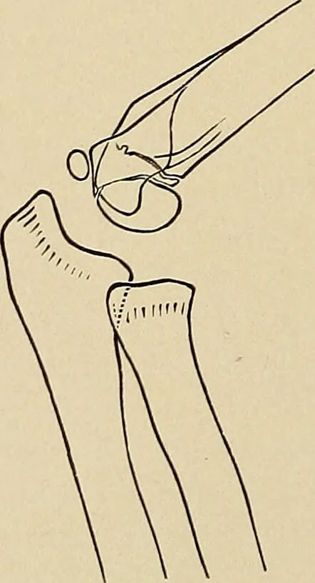 An illustration from Surgical diagnosis / by Edward Martin ... illustrated with 445 engravings and 18 plates in colors and monochrome., 1909, leaf 428