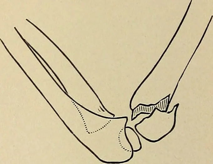 An illustration from Surgical diagnosis / by Edward Martin ... illustrated with 445 engravings and 18 plates in colors and monochrome., 1909, leaf 428