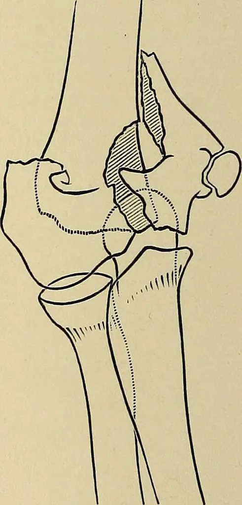 An illustration from Surgical diagnosis / by Edward Martin ... illustrated with 445 engravings and 18 plates in colors and monochrome., 1909, leaf 430
