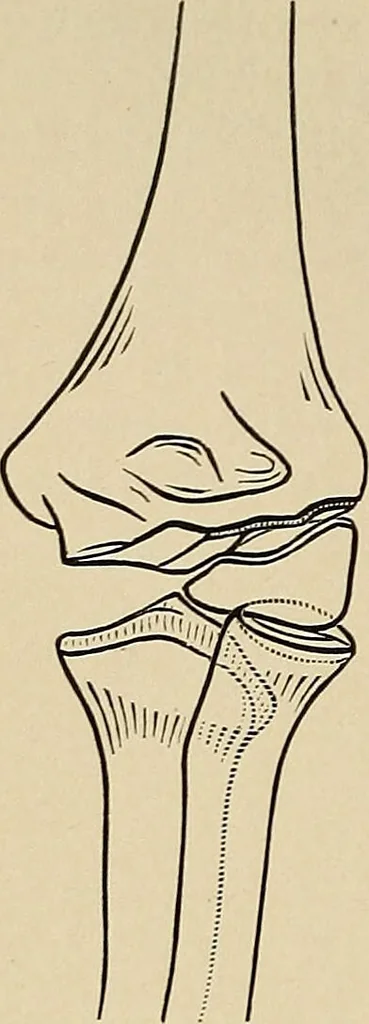 An illustration from Surgical diagnosis / by Edward Martin ... illustrated with 445 engravings and 18 plates in colors and monochrome., 1909, leaf 432