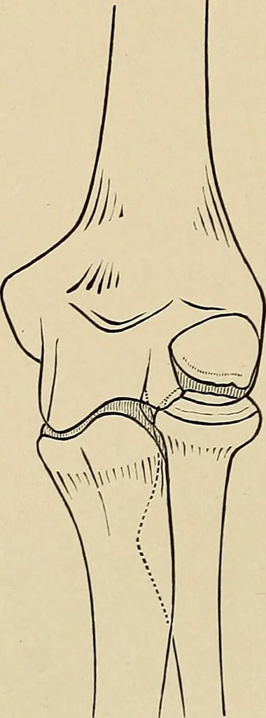 An illustration from Surgical diagnosis / by Edward Martin ... illustrated with 445 engravings and 18 plates in colors and monochrome., 1909, leaf 432