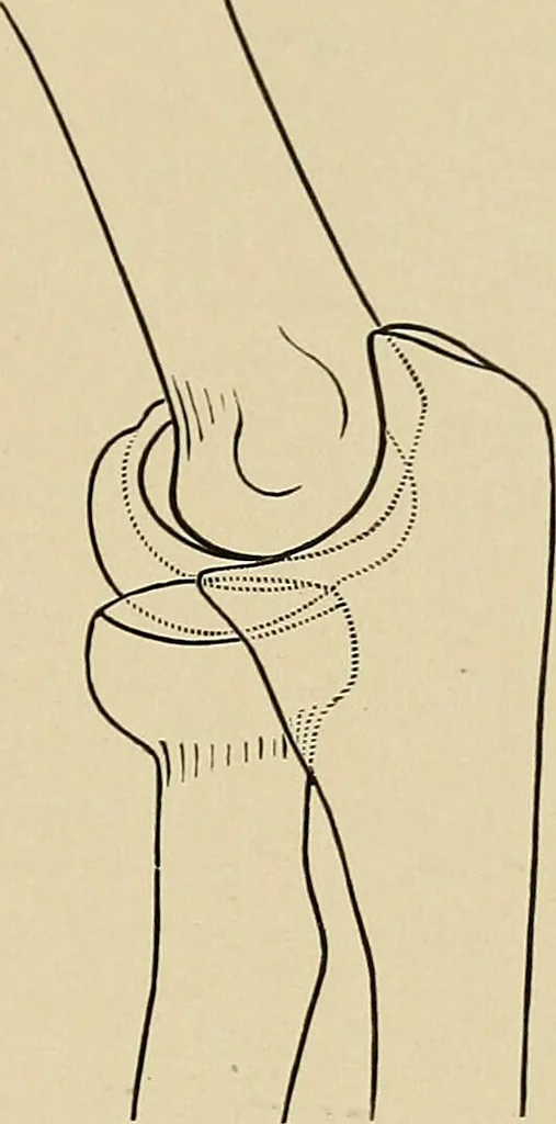 An illustration from Surgical diagnosis / by Edward Martin ... illustrated with 445 engravings and 18 plates in colors and monochrome., 1909, leaf 433