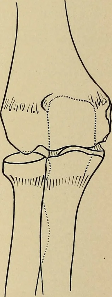 An illustration from Surgical diagnosis / by Edward Martin ... illustrated with 445 engravings and 18 plates in colors and monochrome., 1909, leaf 434