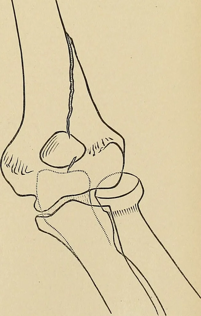 An illustration from Surgical diagnosis / by Edward Martin ... illustrated with 445 engravings and 18 plates in colors and monochrome., 1909, leaf 437
