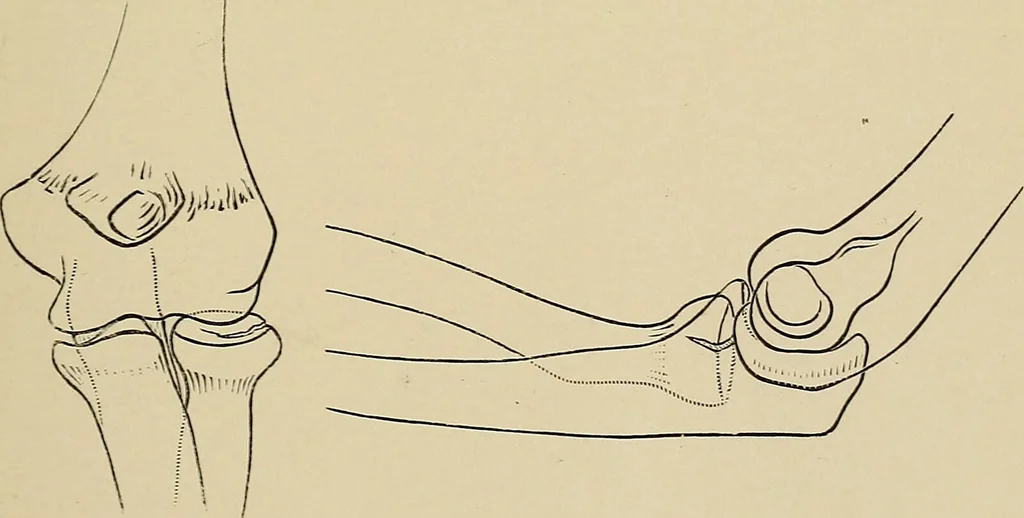 An illustration from Surgical diagnosis / by Edward Martin ... illustrated with 445 engravings and 18 plates in colors and monochrome., 1909, leaf 439