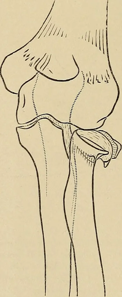 An illustration from Surgical diagnosis / by Edward Martin ... illustrated with 445 engravings and 18 plates in colors and monochrome., 1909, leaf 440