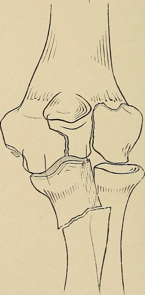 An illustration from Surgical diagnosis / by Edward Martin ... illustrated with 445 engravings and 18 plates in colors and monochrome., 1909, leaf 442