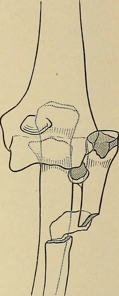 An illustration from Surgical diagnosis / by Edward Martin ... illustrated with 445 engravings and 18 plates in colors and monochrome., 1909, leaf 444
