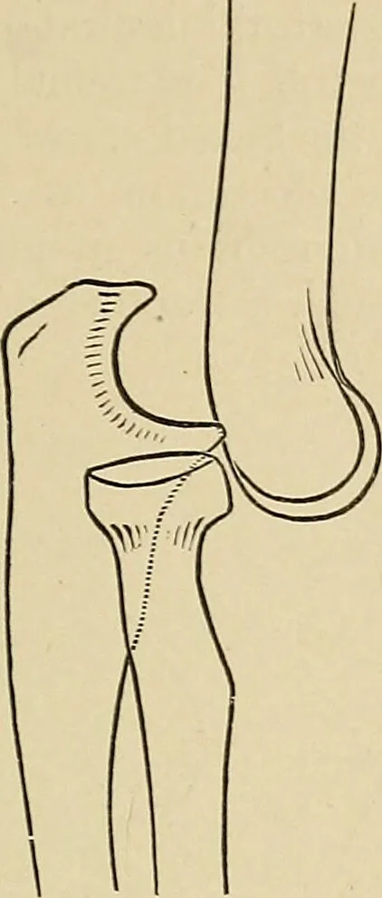 An illustration from Surgical diagnosis / by Edward Martin ... illustrated with 445 engravings and 18 plates in colors and monochrome., 1909, leaf 445