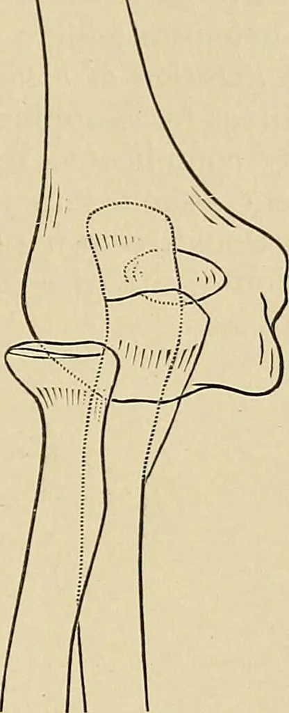 An illustration from Surgical diagnosis / by Edward Martin ... illustrated with 445 engravings and 18 plates in colors and monochrome., 1909, leaf 445