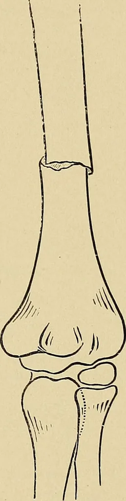 An illustration from Surgical diagnosis / by Edward Martin ... illustrated with 445 engravings and 18 plates in colors and monochrome., 1909, leaf 455