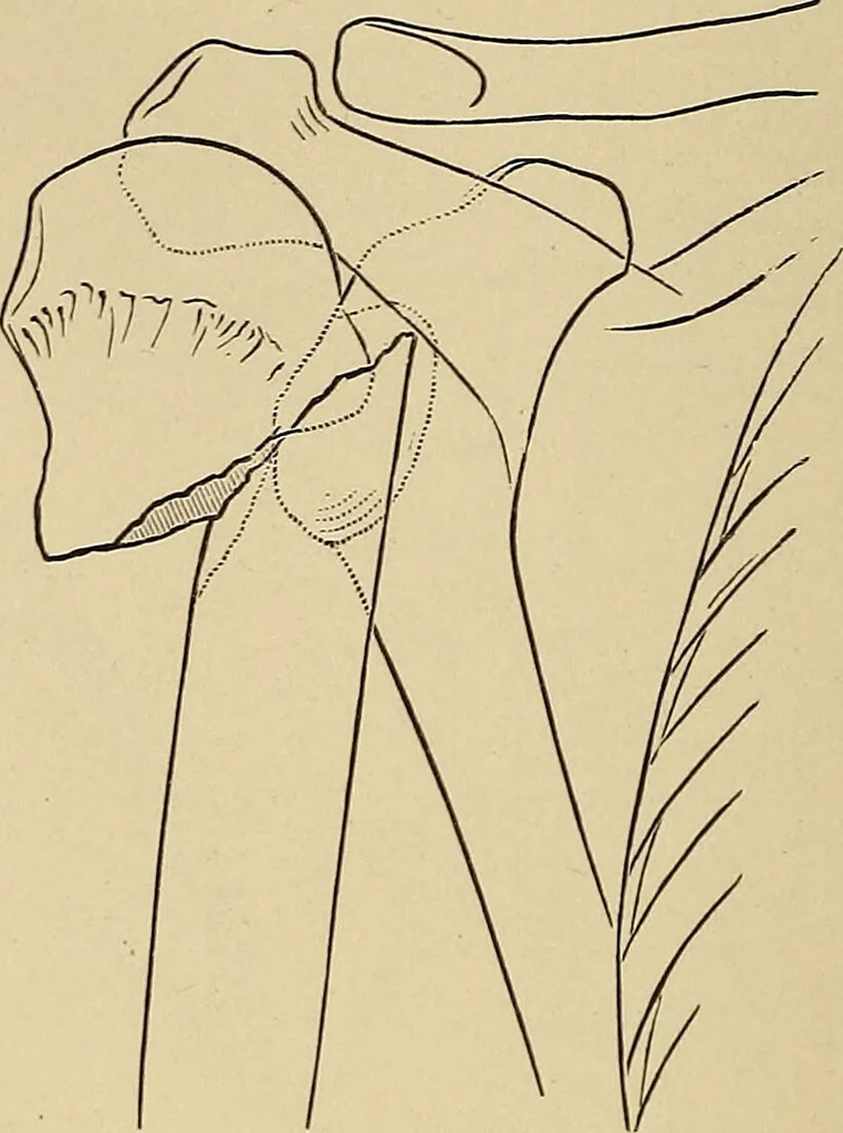 An illustration from Surgical diagnosis / by Edward Martin ... illustrated with 445 engravings and 18 plates in colors and monochrome., 1909, leaf 462
