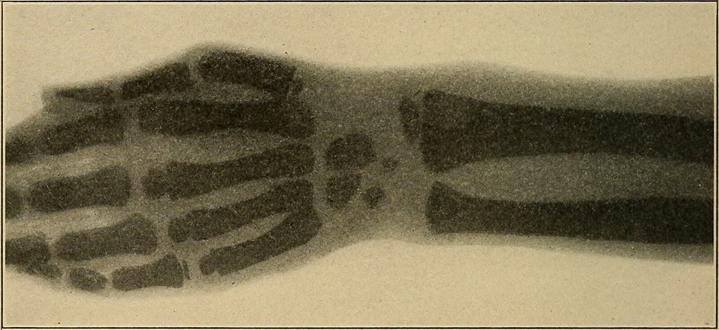 An illustration from Surgical diagnosis / by Edward Martin ... illustrated with 445 engravings and 18 plates in colors and monochrome., 1909, leaf 56