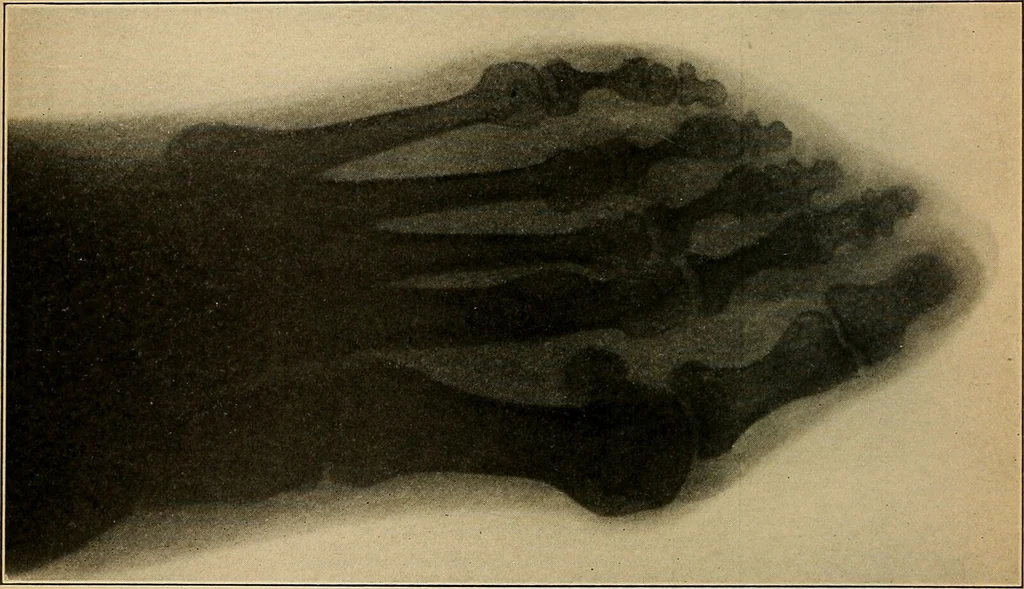 An illustration from Surgical diagnosis / by Edward Martin ... illustrated with 445 engravings and 18 plates in colors and monochrome., 1909, leaf 58