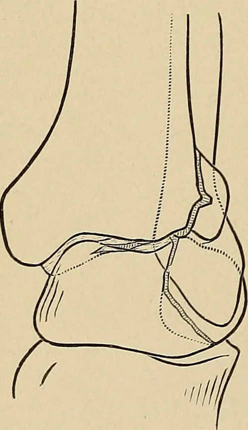 An illustration from Surgical diagnosis / by Edward Martin ... illustrated with 445 engravings and 18 plates in colors and monochrome., 1909, leaf 602