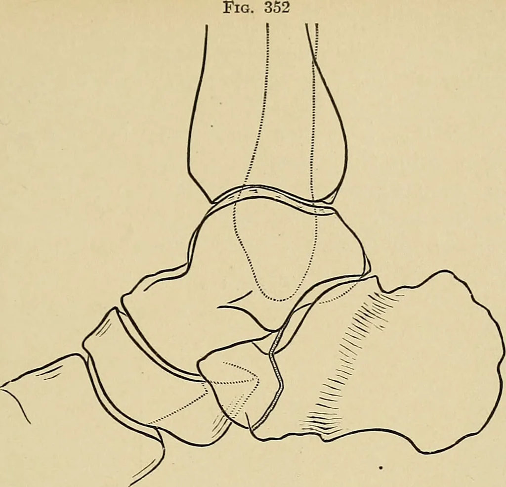 An illustration from Surgical diagnosis / by Edward Martin ... illustrated with 445 engravings and 18 plates in colors and monochrome., 1909, leaf 603