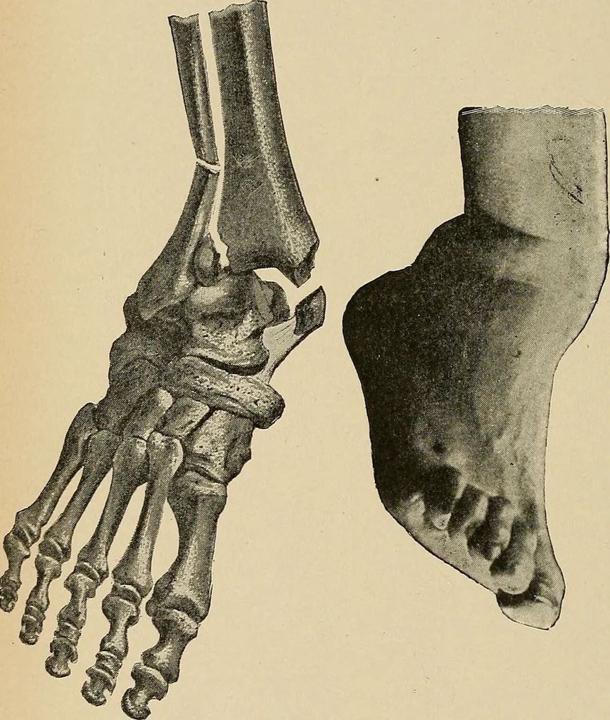 An illustration from Surgical diagnosis / by Edward Martin ... illustrated with 445 engravings and 18 plates in colors and monochrome., 1909, leaf 604
