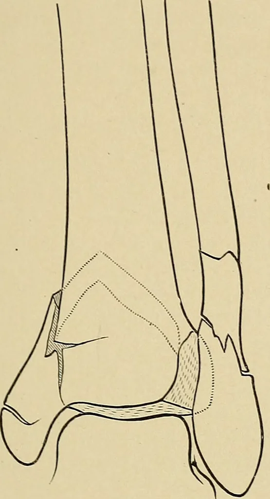 An illustration from Surgical diagnosis / by Edward Martin ... illustrated with 445 engravings and 18 plates in colors and monochrome., 1909, leaf 611