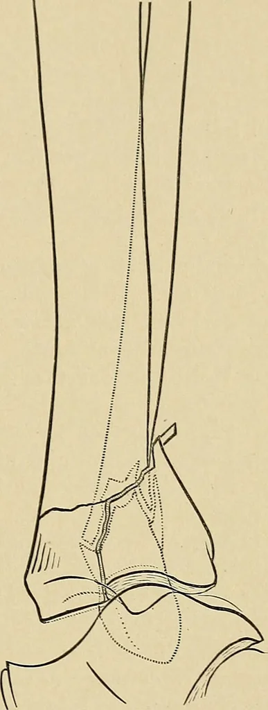An illustration from Surgical diagnosis / by Edward Martin ... illustrated with 445 engravings and 18 plates in colors and monochrome., 1909, leaf 611