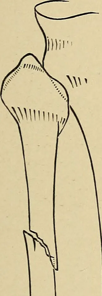 An illustration from Surgical diagnosis / by Edward Martin ... illustrated with 445 engravings and 18 plates in colors and monochrome., 1909, leaf 621