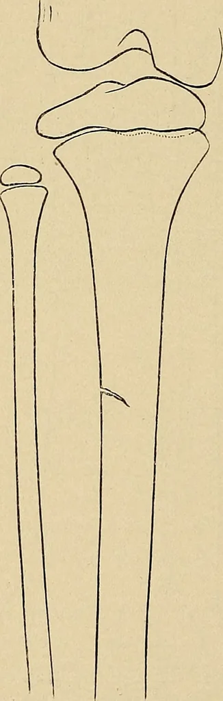An illustration from Surgical diagnosis / by Edward Martin ... illustrated with 445 engravings and 18 plates in colors and monochrome., 1909, leaf 622