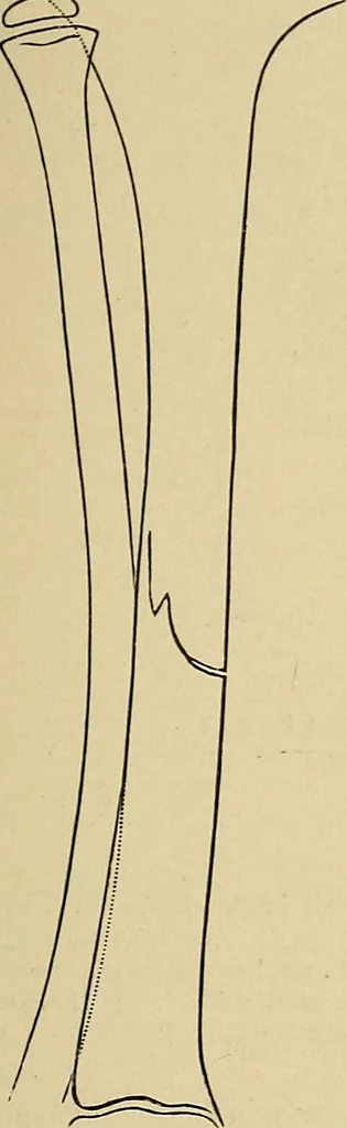 An illustration from Surgical diagnosis / by Edward Martin ... illustrated with 445 engravings and 18 plates in colors and monochrome., 1909, leaf 623