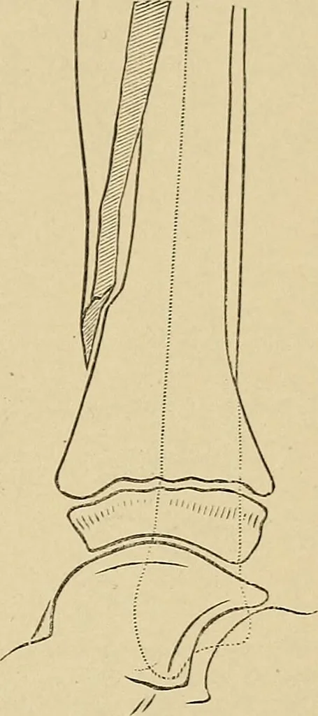 An illustration from Surgical diagnosis / by Edward Martin ... illustrated with 445 engravings and 18 plates in colors and monochrome., 1909, leaf 623