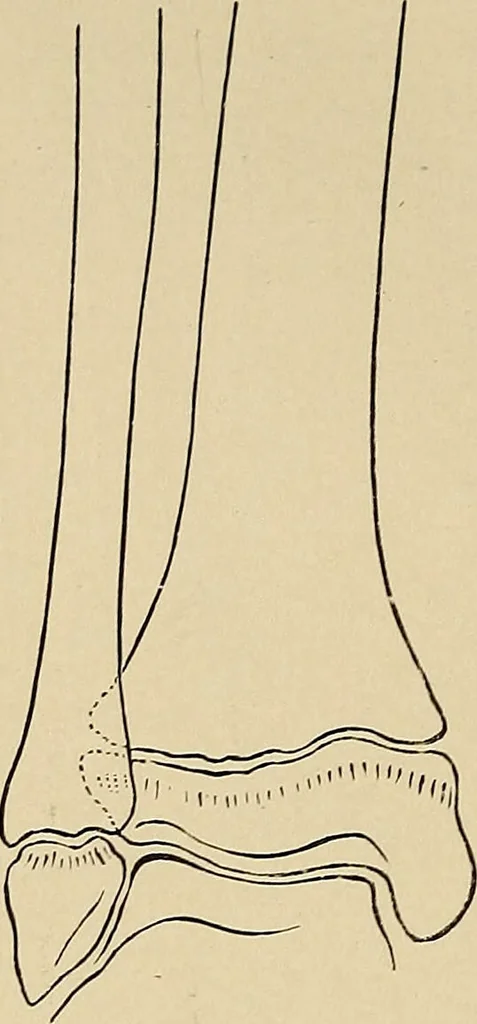 An illustration from Surgical diagnosis / by Edward Martin ... illustrated with 445 engravings and 18 plates in colors and monochrome., 1909, leaf 624