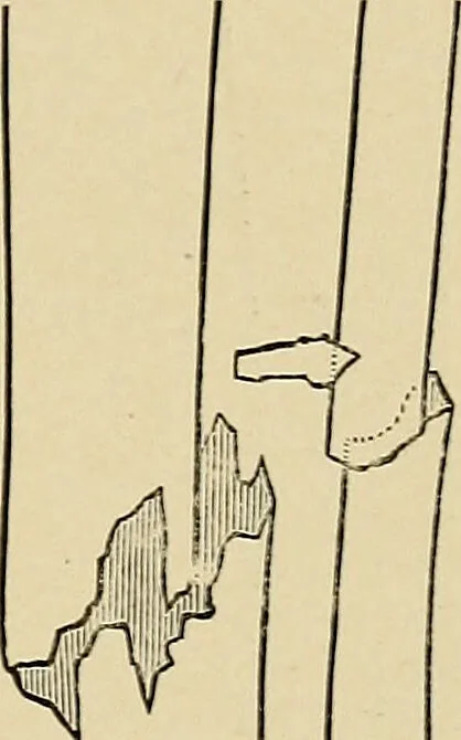 An illustration from Surgical diagnosis / by Edward Martin ... illustrated with 445 engravings and 18 plates in colors and monochrome., 1909, leaf 625
