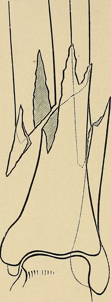 An illustration from Surgical diagnosis / by Edward Martin ... illustrated with 445 engravings and 18 plates in colors and monochrome., 1909, leaf 628