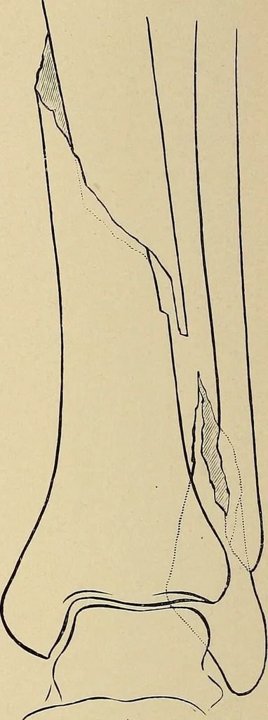An illustration from Surgical diagnosis / by Edward Martin ... illustrated with 445 engravings and 18 plates in colors and monochrome., 1909, leaf 628
