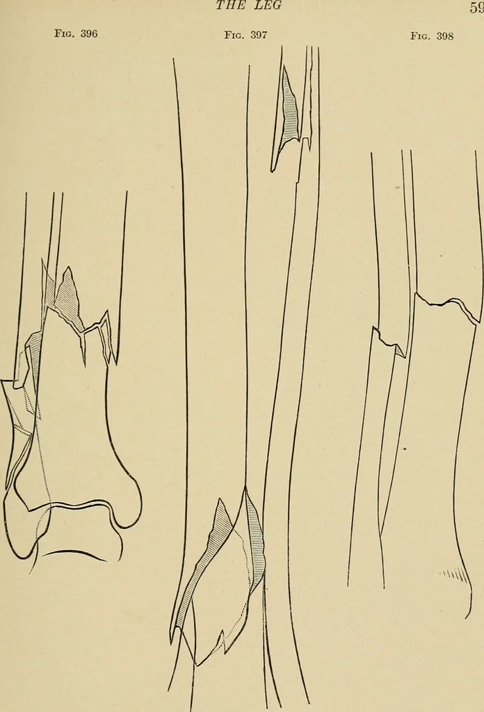 An illustration from Surgical diagnosis / by Edward Martin ... illustrated with 445 engravings and 18 plates in colors and monochrome., 1909, leaf 629