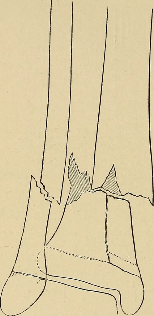 An illustration from Surgical diagnosis / by Edward Martin ... illustrated with 445 engravings and 18 plates in colors and monochrome., 1909, leaf 630