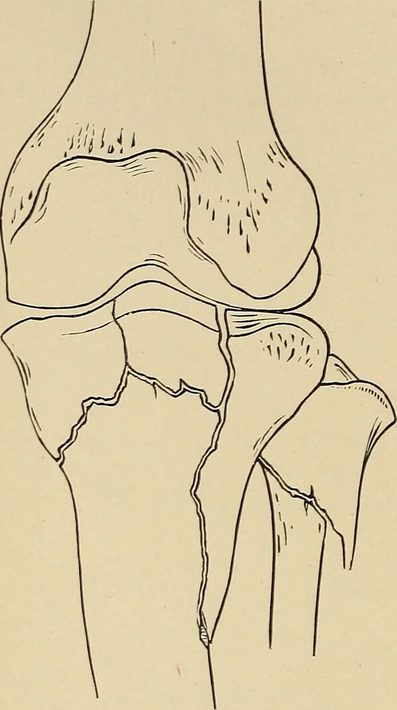 An illustration from Surgical diagnosis / by Edward Martin ... illustrated with 445 engravings and 18 plates in colors and monochrome., 1909, leaf 640