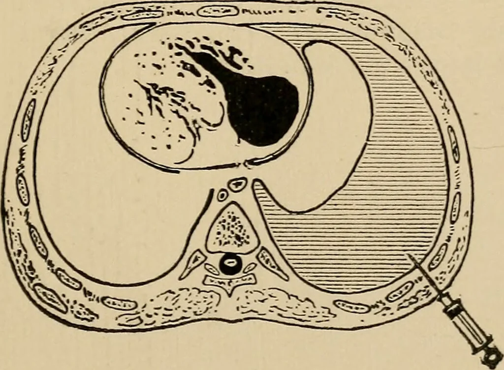 An illustration from Atlas of methods of clinical investigation : with an epitome of clinical diagnosis and of special pathology and treatment of internal diseases / By Dr. Christfried Jakob ... Authorized translation from the German. Ed. by Augustus A. Eshner ... With 182 colored illustrations upon 68 plates, and 64 illustrations in the text., 1898, leaf 121