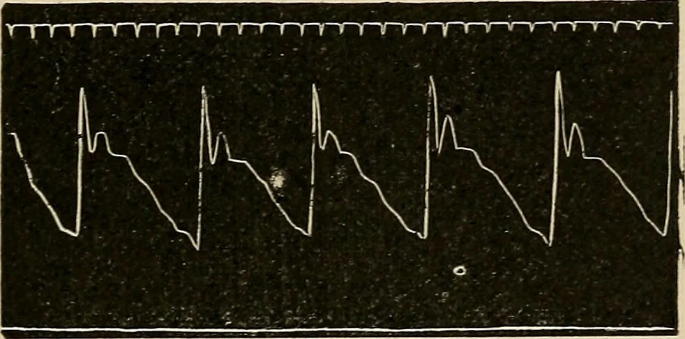 An illustration from Atlas of methods of clinical investigation : with an epitome of clinical diagnosis and of special pathology and treatment of internal diseases / By Dr. Christfried Jakob ... Authorized translation from the German. Ed. by Augustus A. Eshner ... With 182 colored illustrations upon 68 plates, and 64 illustrations in the text., 1898, leaf 297
