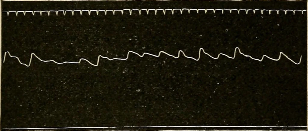 An illustration from Atlas of methods of clinical investigation : with an epitome of clinical diagnosis and of special pathology and treatment of internal diseases / By Dr. Christfried Jakob ... Authorized translation from the German. Ed. by Augustus A. Eshner ... With 182 colored illustrations upon 68 plates, and 64 illustrations in the text., 1898, leaf 299