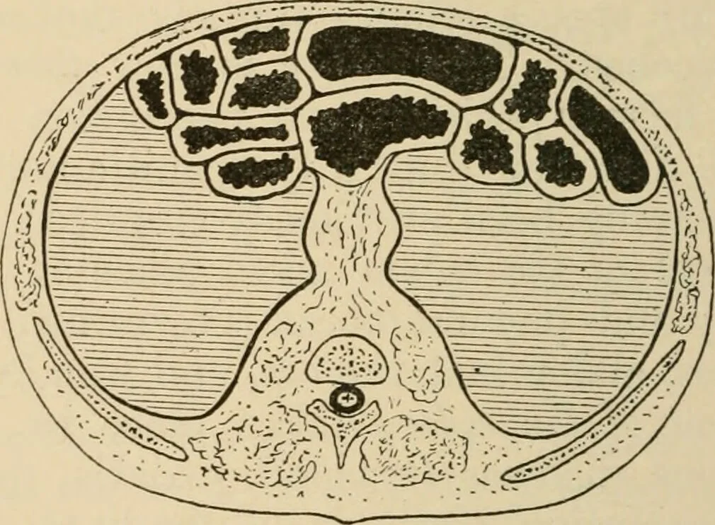 An illustration from Atlas of methods of clinical investigation : with an epitome of clinical diagnosis and of special pathology and treatment of internal diseases / By Dr. Christfried Jakob ... Authorized translation from the German. Ed. by Augustus A. Eshner ... With 182 colored illustrations upon 68 plates, and 64 illustrations in the text., 1898, leaf 322