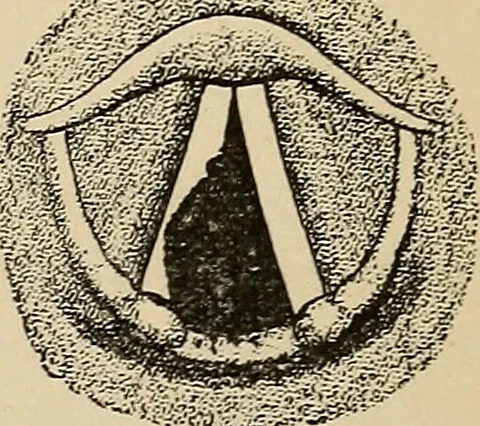 An illustration from Atlas of methods of clinical investigation : with an epitome of clinical diagnosis and of special pathology and treatment of internal diseases / By Dr. Christfried Jakob ... Authorized translation from the German. Ed. by Augustus A. Eshner ... With 182 colored illustrations upon 68 plates, and 64 illustrations in the text., 1898, leaf 361