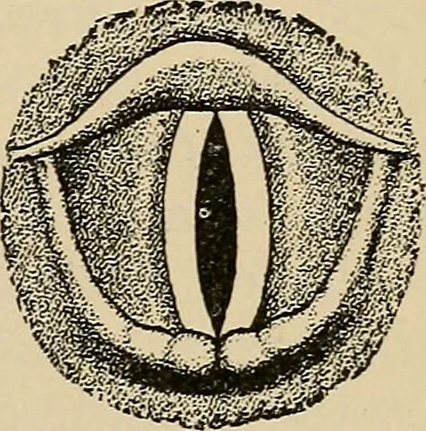 An illustration from Atlas of methods of clinical investigation : with an epitome of clinical diagnosis and of special pathology and treatment of internal diseases / By Dr. Christfried Jakob ... Authorized translation from the German. Ed. by Augustus A. Eshner ... With 182 colored illustrations upon 68 plates, and 64 illustrations in the text., 1898, leaf 391