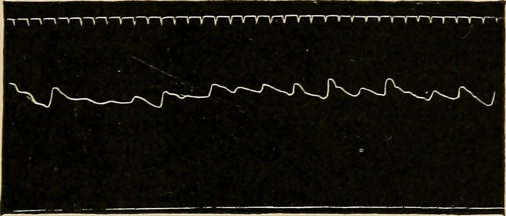 An illustration from Atlas of methods of clinical investigation : with an epitome of clinical diagnosis and of special pathology and treatment of internal diseases / By Dr. Christfried Jakob ... Authorized translation from the German. Ed. by Augustus A. Eshner ... With 182 colored illustrations upon 68 plates, and 64 illustrations in the text., 1898, leaf 409