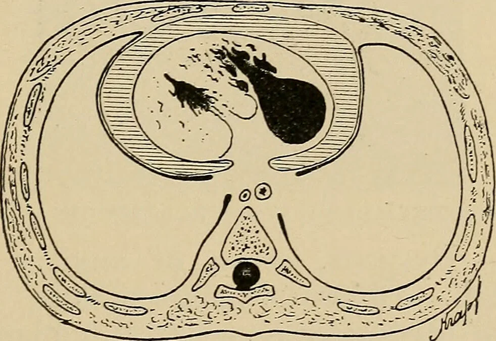 An illustration from Atlas of methods of clinical investigation : with an epitome of clinical diagnosis and of special pathology and treatment of internal diseases / By Dr. Christfried Jakob ... Authorized translation from the German. Ed. by Augustus A. Eshner ... With 182 colored illustrations upon 68 plates, and 64 illustrations in the text., 1898, leaf 415