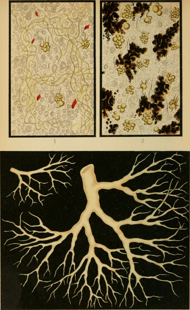 An illustration from Atlas of methods of clinical investigation : with an epitome of clinical diagnosis and of special pathology and treatment of internal diseases / By Dr. Christfried Jakob ... Authorized translation from the German. Ed. by Augustus A. Eshner ... With 182 colored illustrations upon 68 plates, and 64 illustrations in the text., 1898, leaf 46