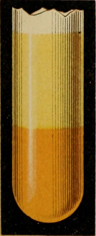 An illustration from Atlas of methods of clinical investigation : with an epitome of clinical diagnosis and of special pathology and treatment of internal diseases / By Dr. Christfried Jakob ... Authorized translation from the German. Ed. by Augustus A. Eshner ... With 182 colored illustrations upon 68 plates, and 64 illustrations in the text., 1898, leaf 77