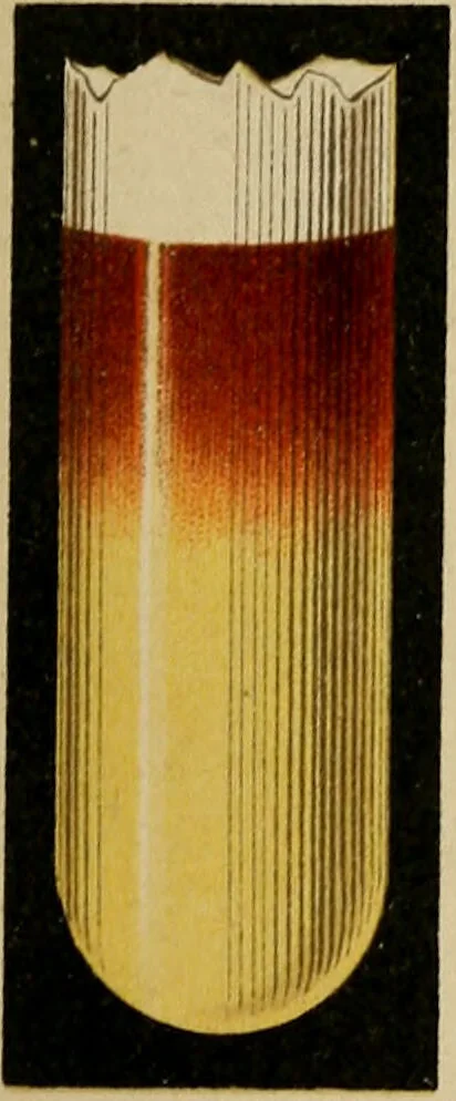An illustration from Atlas of methods of clinical investigation : with an epitome of clinical diagnosis and of special pathology and treatment of internal diseases / By Dr. Christfried Jakob ... Authorized translation from the German. Ed. by Augustus A. Eshner ... With 182 colored illustrations upon 68 plates, and 64 illustrations in the text., 1898, leaf 77