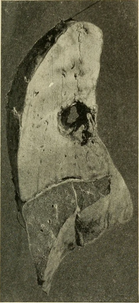 An illustration from The diseases of infancy and childhood : for the use of students and practitioners of medicine / by L. Emmett Holt and John Howland., 1911, leaf 1085